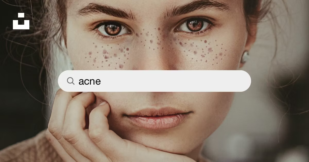11 Effective Ways to Banish Redness from Pimples and Acne